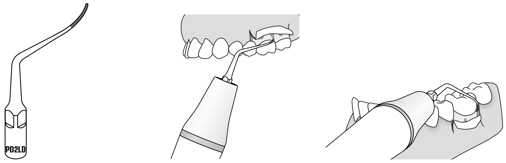 Сфера применения наконечника для скалера